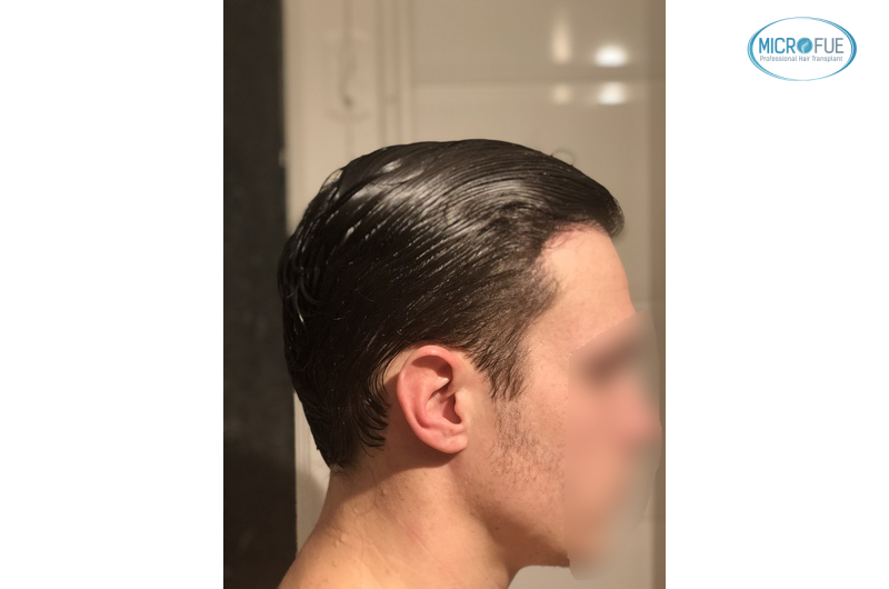 trasplante capilar sin cortar el pelo Microfue (15) trasplante capilar sin cortar el pelo Microfue (15)