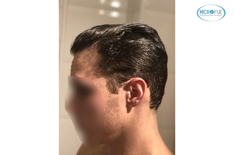 trasplante capilar sin cortar el pelo Microfue (16) trasplante capilar sin cortar el pelo Microfue (16)