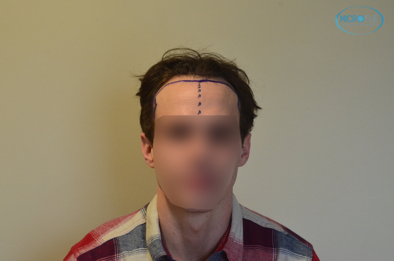 trasplante capilar sin cortar el pelo Microfue (2) trasplante capilar sin cortar el pelo Microfue (2)