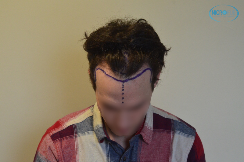 trasplante capilar sin cortar el pelo Microfue (3) trasplante capilar sin cortar el pelo Microfue (3)