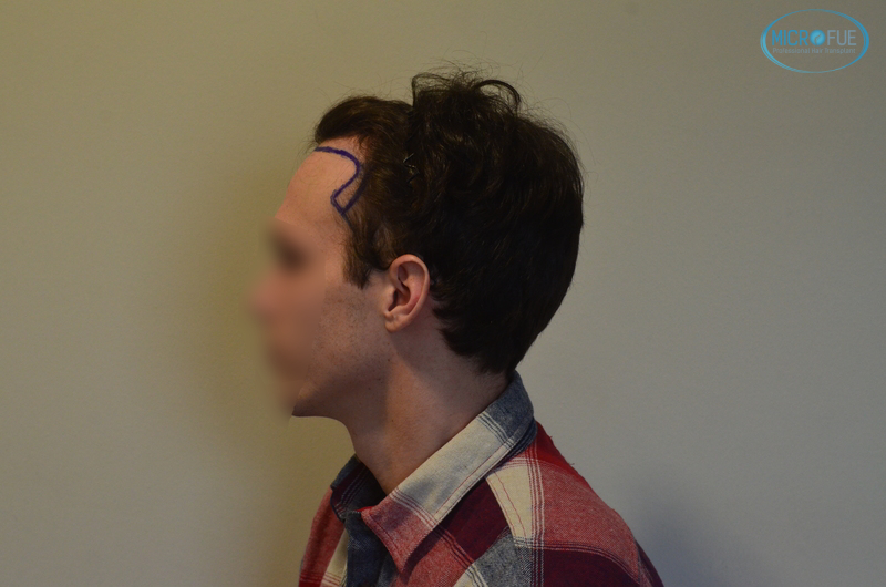 trasplante capilar sin cortar el pelo Microfue (4) trasplante capilar sin cortar el pelo Microfue (4)