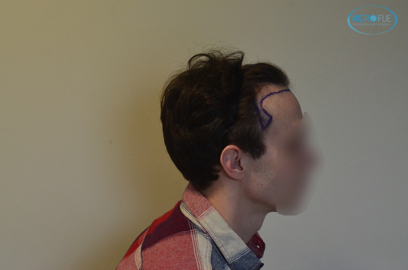 trasplante capilar sin cortar el pelo Microfue (5) trasplante capilar sin cortar el pelo Microfue (5)
