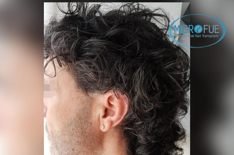 Evolución de trasplante capilar microfue Evolución de trasplante capilar microfue