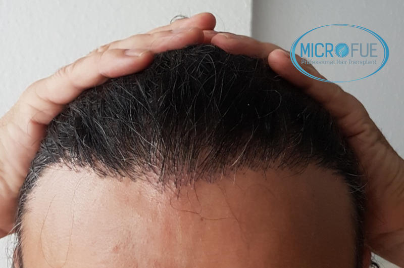 Evolución de trasplante capilar microfue Evolución de trasplante capilar microfue