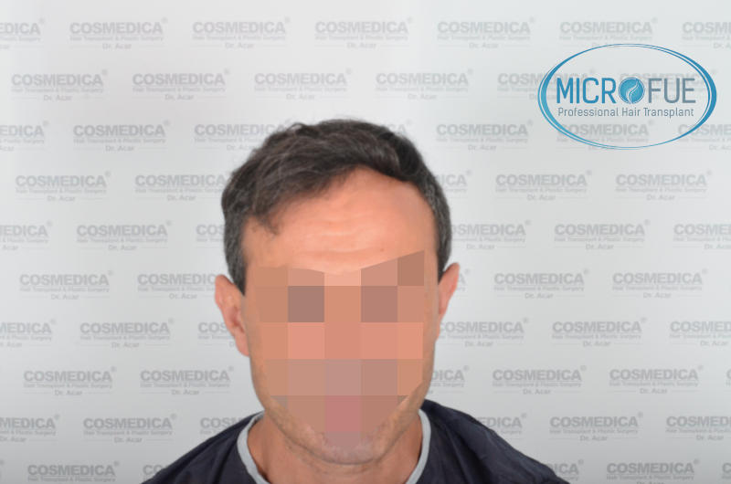 Evolución de trasplante capilar microfue Evolución de trasplante capilar microfue