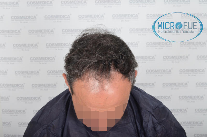 Evolución de trasplante capilar microfue Evolución de trasplante capilar microfue