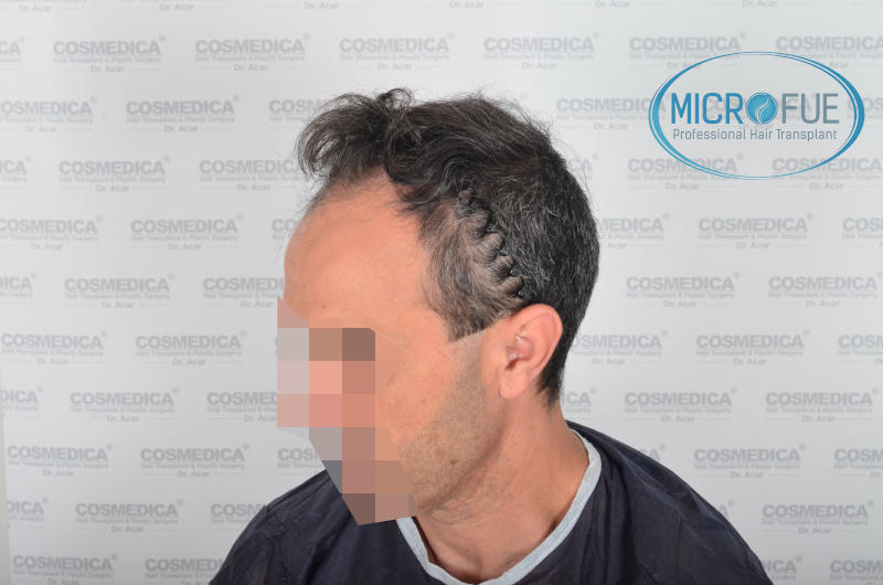 Evolución de trasplante capilar microfue Evolución de trasplante capilar microfue