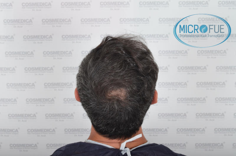Evolución de trasplante capilar microfue Evolución de trasplante capilar microfue