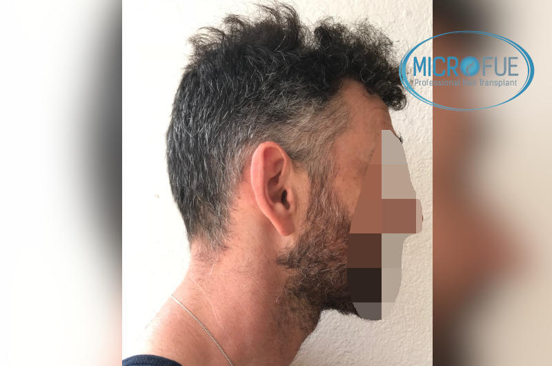 Antes y despues - Evolución de trasplante capilar Antes y despues - Evolución de trasplante capilar