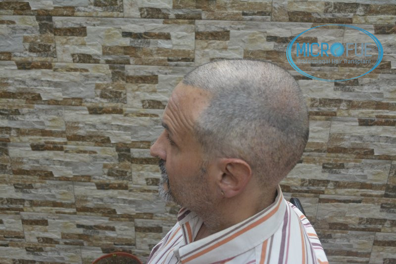 Injerto capilar en coronilla - Antes y después Injerto capilar en coronilla - Antes y después