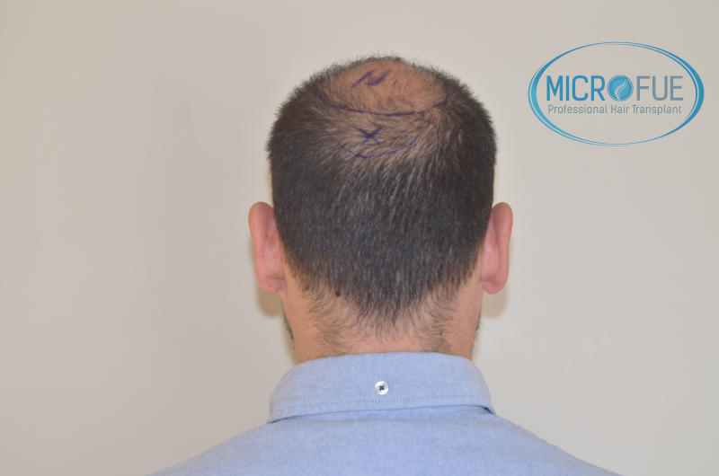 foto resultado trasplante de pelo turquia foto resultado trasplante de pelo turquia