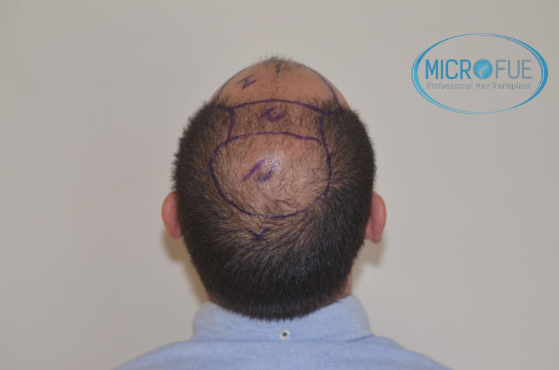 foto resultado trasplante de pelo turquia foto resultado trasplante de pelo turquia