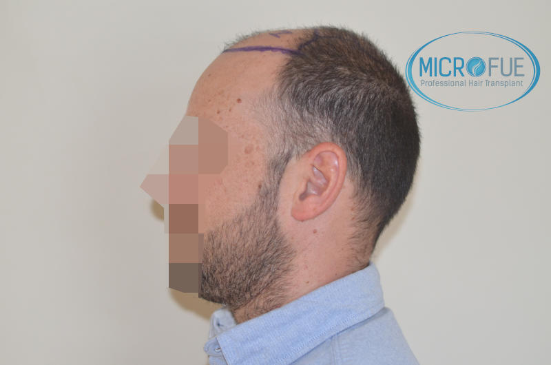 foto resultado trasplante de pelo turquia foto resultado trasplante de pelo turquia