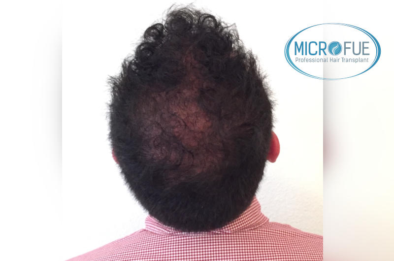 foto resultado trasplante de pelo turquia foto resultado trasplante de pelo turquia