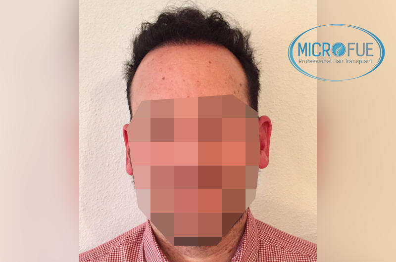 foto resultado trasplante de pelo turquia foto resultado trasplante de pelo turquia