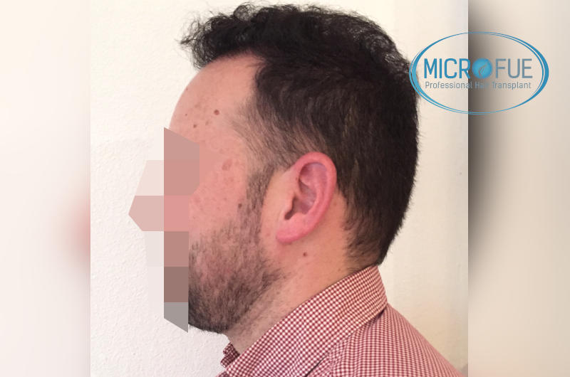 foto resultado trasplante de pelo turquia foto resultado trasplante de pelo turquia