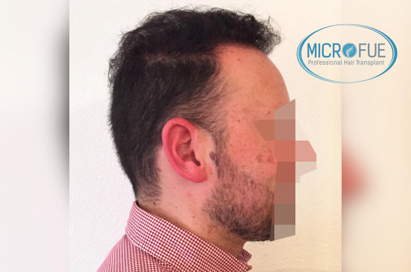 foto resultado trasplante de pelo turquia foto resultado trasplante de pelo turquia