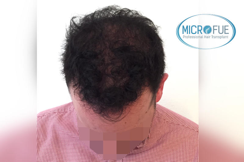 foto resultado trasplante de pelo turquia foto resultado trasplante de pelo turquia
