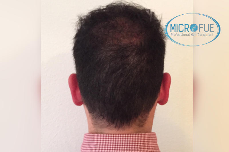 foto resultado trasplante de pelo turquia foto resultado trasplante de pelo turquia