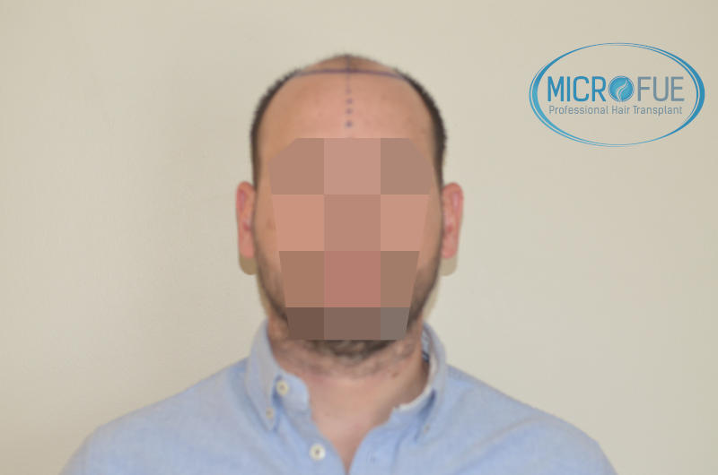 foto resultado trasplante de pelo turquia foto resultado trasplante de pelo turquia