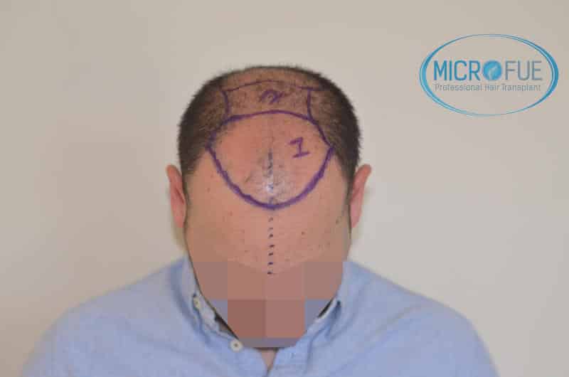 foto resultado trasplante de pelo turquia foto resultado trasplante de pelo turquia