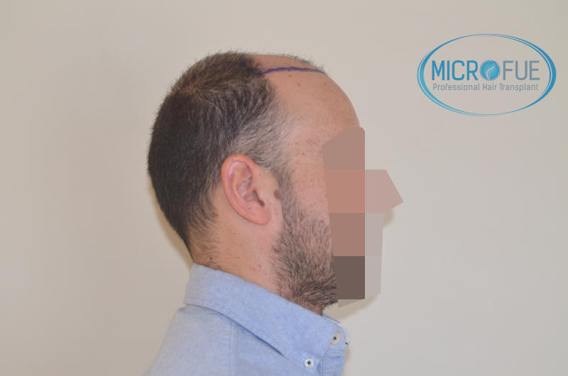 foto resultado trasplante de pelo turquia foto resultado trasplante de pelo turquia