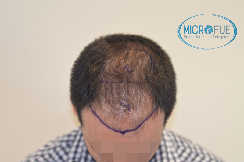 Trasplante de pelo en Turquia - Antes y después Trasplante de pelo en Turquia - Antes y después