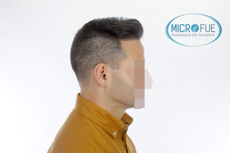 Trasplante de pelo en Turquia - Antes y después Trasplante de pelo en Turquia - Antes y después