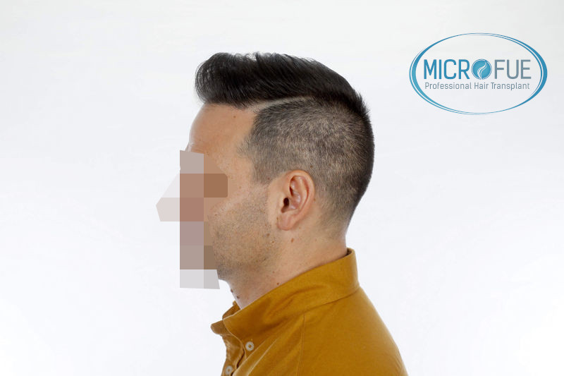 Trasplante de pelo en Turquia - Antes y después