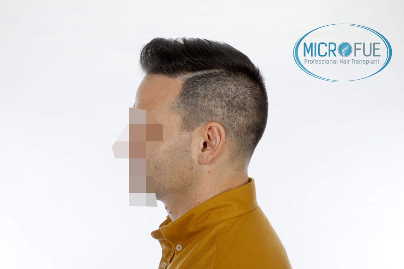 Trasplante de pelo en Turquia - Antes y después Trasplante de pelo en Turquia - Antes y después