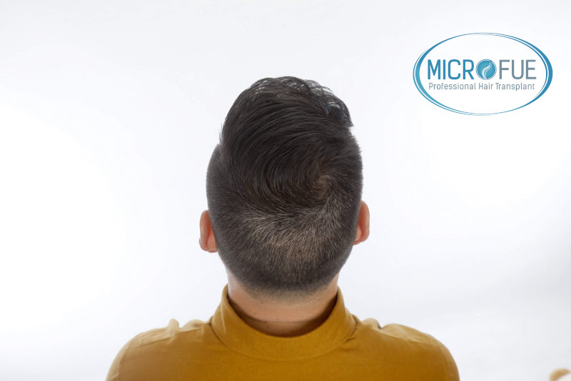 Trasplante de pelo en Turquia - Antes y después Trasplante de pelo en Turquia - Antes y después