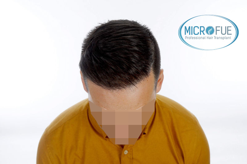Trasplante de pelo en Turquia - Antes y después Trasplante de pelo en Turquia - Antes y después
