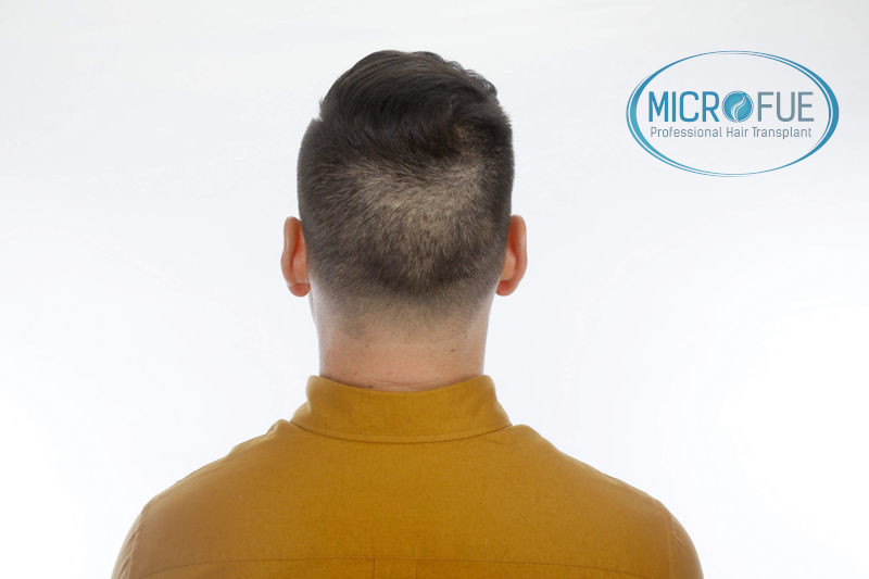 Trasplante de pelo en Turquia - Antes y después Trasplante de pelo en Turquia - Antes y después
