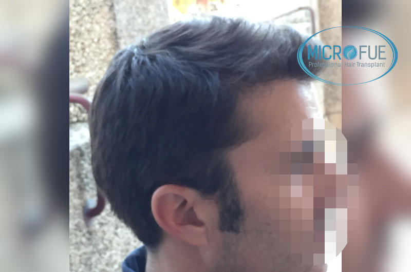 Trasplante de pelo en turquía - Resultados con comparativa antes y después Trasplante de pelo en turquía - Resultados con comparativa antes y después
