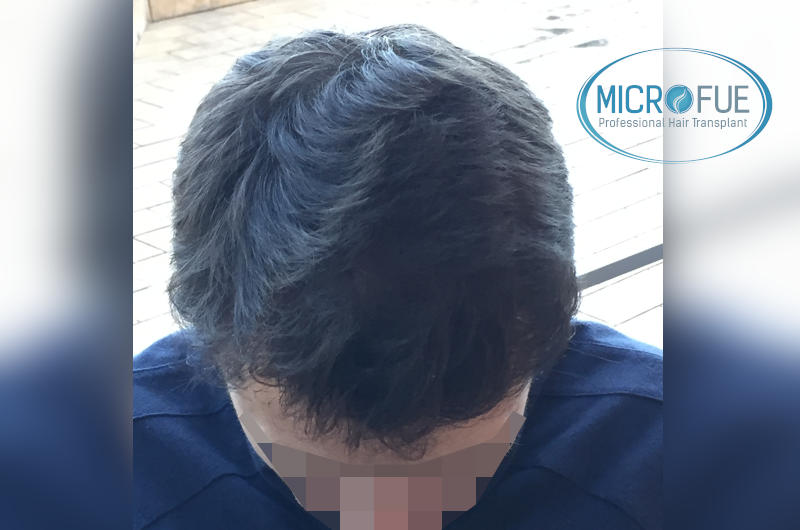 Trasplante de pelo en turquía - Resultados con comparativa antes y después