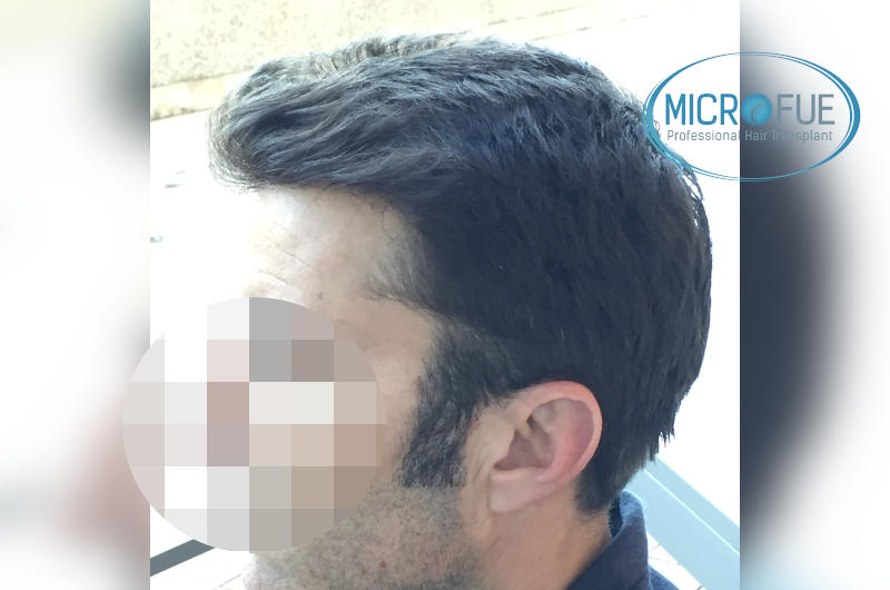 Trasplante de pelo en turquía - Resultados con comparativa antes y después Trasplante de pelo en turquía - Resultados con comparativa antes y después