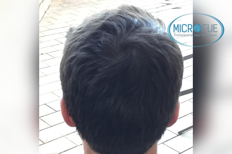 Trasplante de pelo en turquía - Resultados con comparativa antes y después