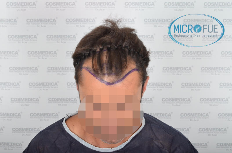 Trasplante de pelo en turquía - Resultados con comparativa antes y después Trasplante de pelo en turquía - Resultados con comparativa antes y después