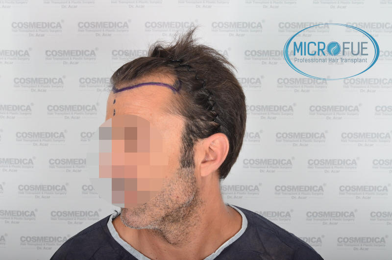 Trasplante de pelo en turquía - Resultados con comparativa antes y después Trasplante de pelo en turquía - Resultados con comparativa antes y después