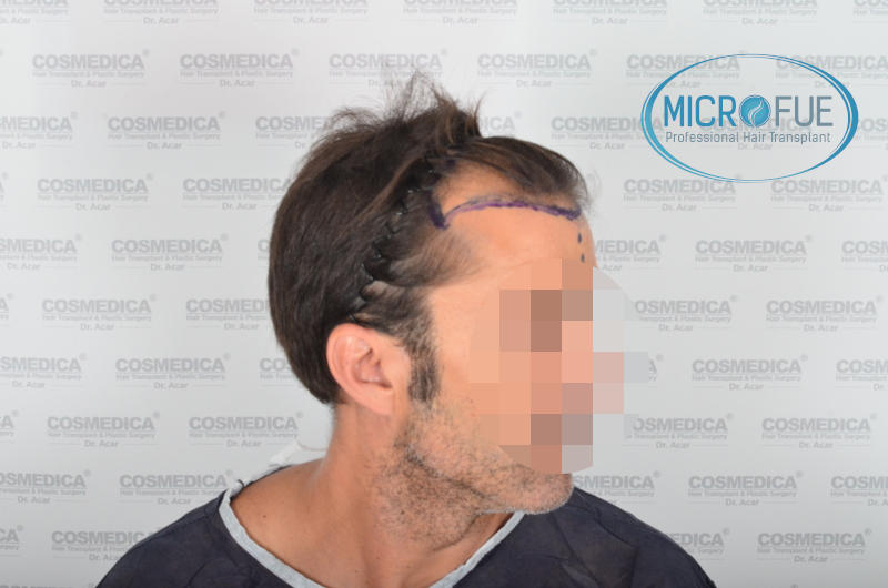 Trasplante de pelo en turquía - Resultados con comparativa antes y después Trasplante de pelo en turquía - Resultados con comparativa antes y después