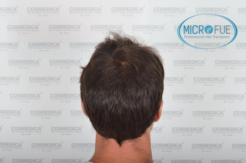 Trasplante de pelo en turquía - Resultados con comparativa antes y después Trasplante de pelo en turquía - Resultados con comparativa antes y después