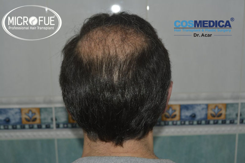 Trasplante capilar - Pacientes de microfue Trasplante capilar - Pacientes de microfue