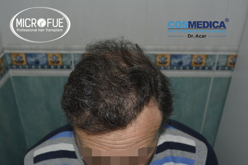 Trasplante capilar - Pacientes de microfue Trasplante capilar - Pacientes de microfue
