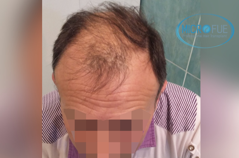 Trasplante capilar - Pacientes de microfue Trasplante capilar - Pacientes de microfue