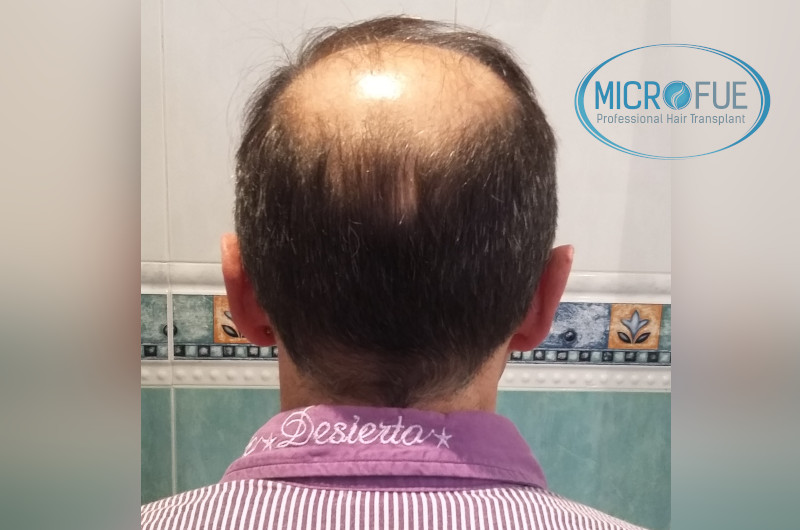 Trasplante capilar - Pacientes de microfue Trasplante capilar - Pacientes de microfue