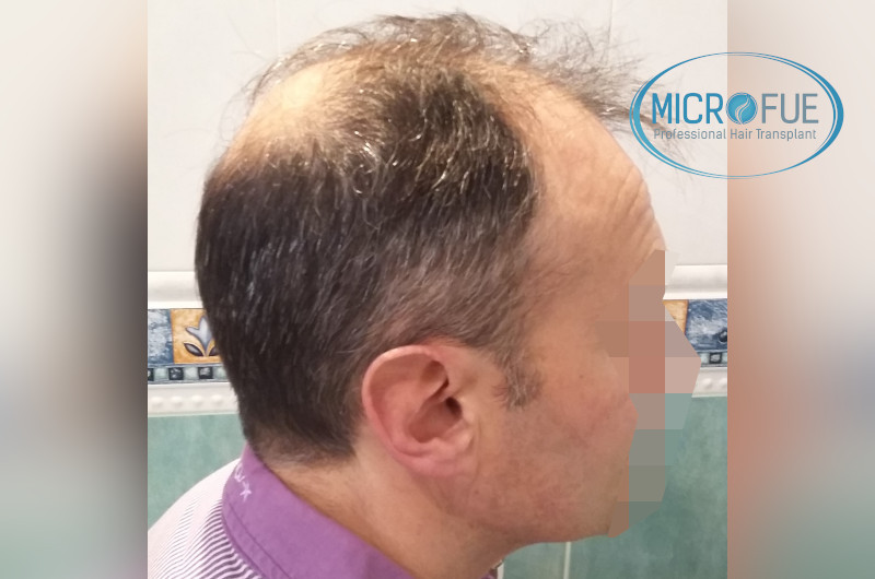 Trasplante capilar - Pacientes de microfue Trasplante capilar - Pacientes de microfue