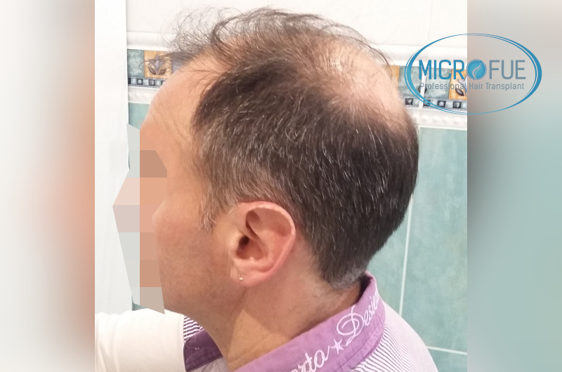 Trasplante capilar - Pacientes de microfue Trasplante capilar - Pacientes de microfue