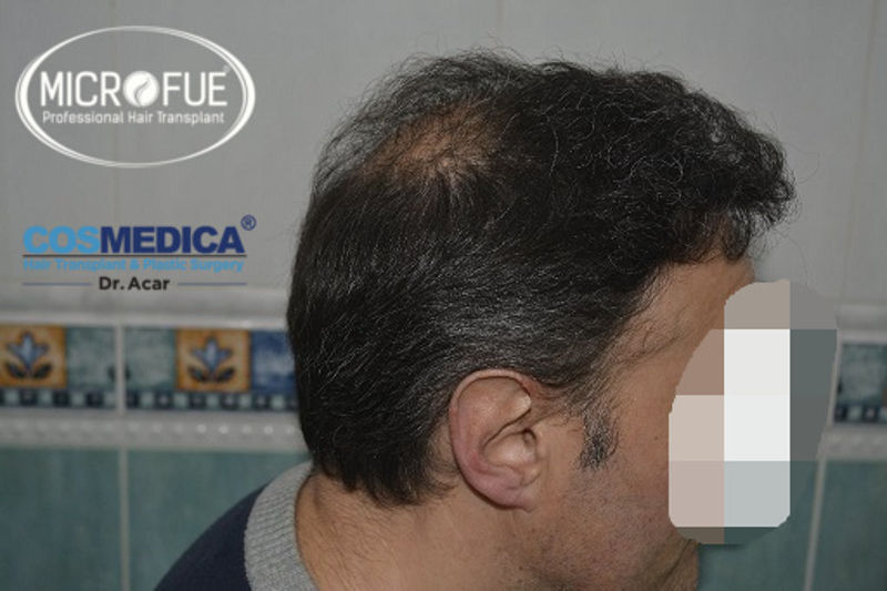 Trasplante capilar - Pacientes de microfue Trasplante capilar - Pacientes de microfue