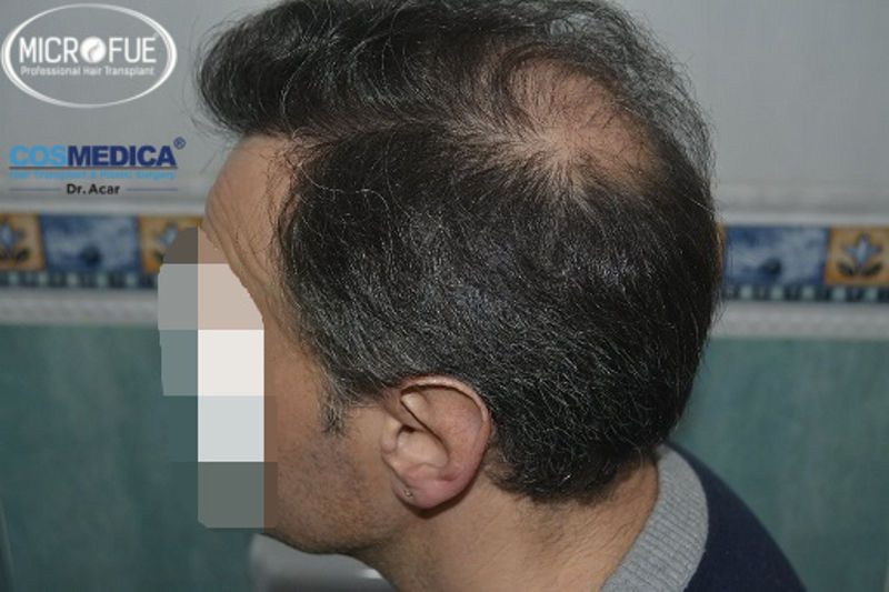 Trasplante capilar - Pacientes de microfue Trasplante capilar - Pacientes de microfue