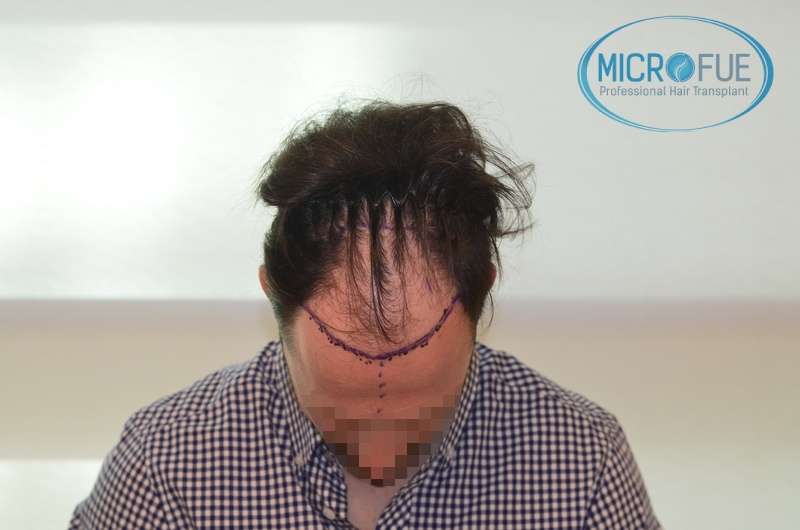 Evolución de trasplante de pelo en entradas Evolución de trasplante de pelo en entradas